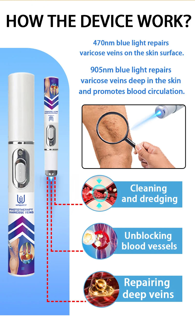 Laser Indolore Contre la Varices
