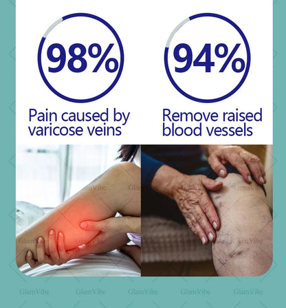 Laser Indolore Contre la Varices