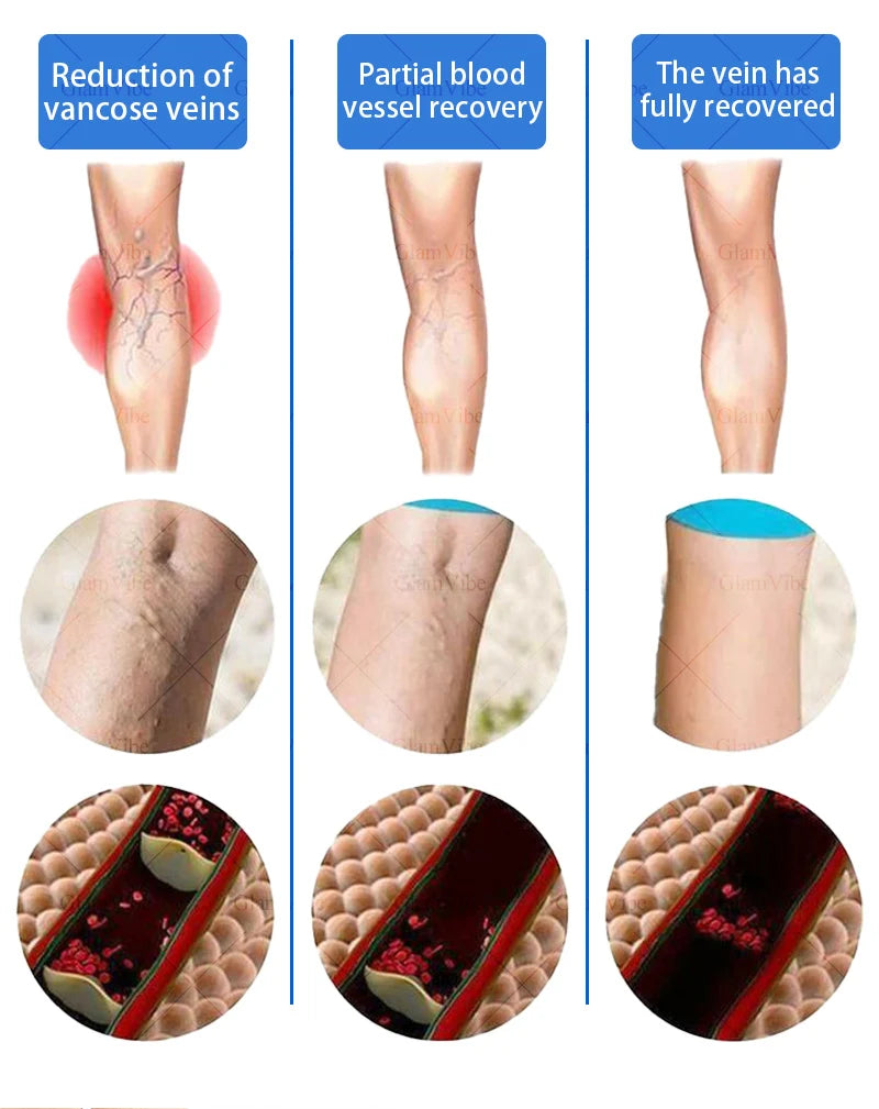 Laser Indolore Contre la Varices
