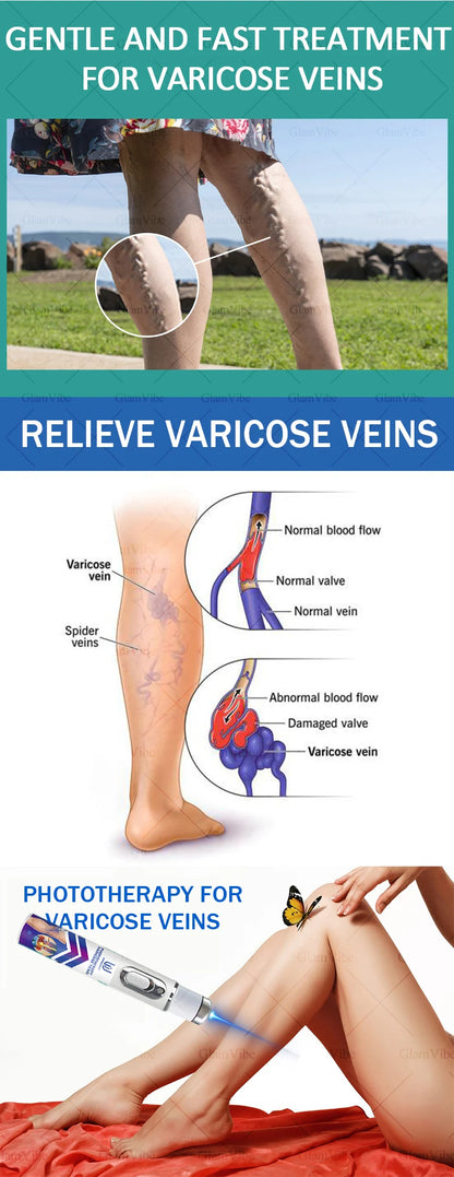 Laser Indolore Contre la Varices