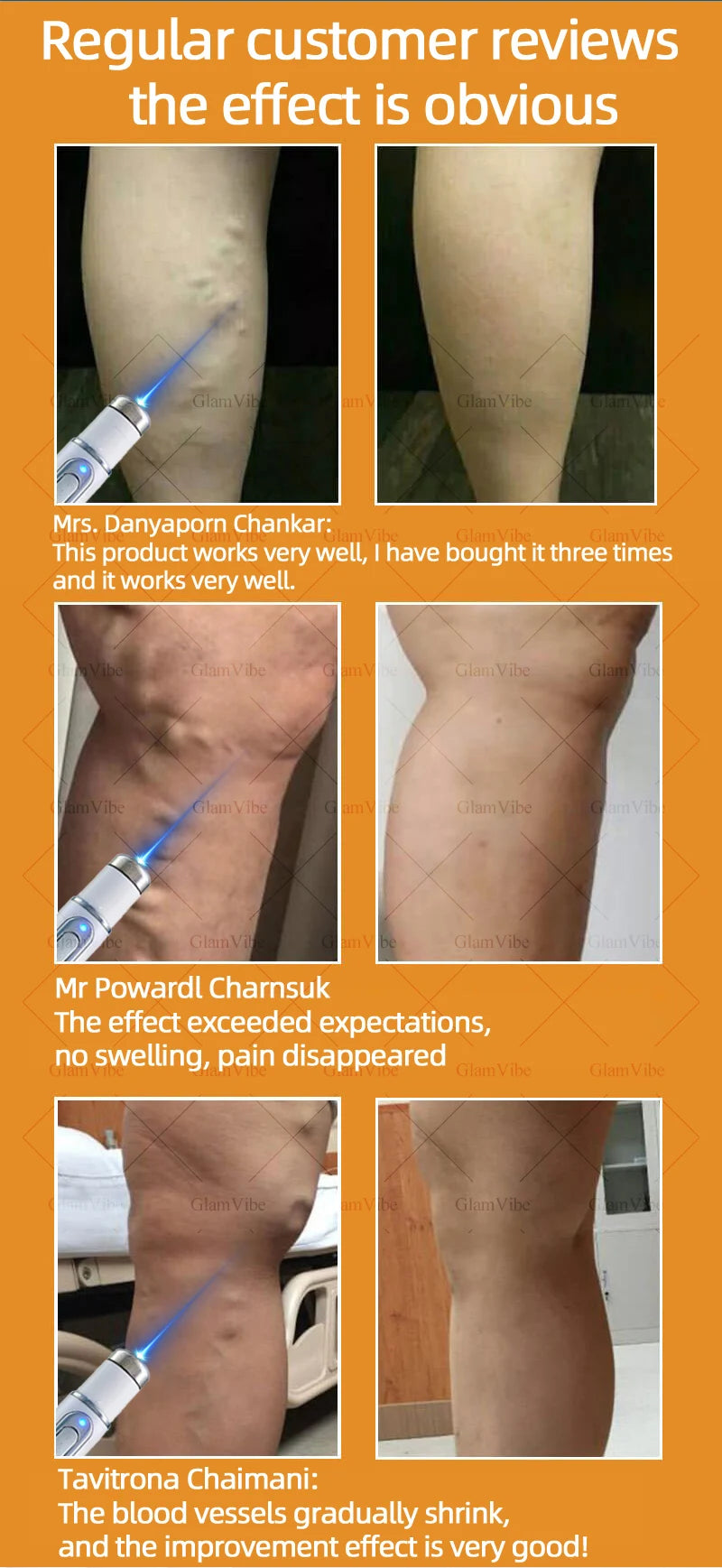 Laser Indolore Contre la Varices