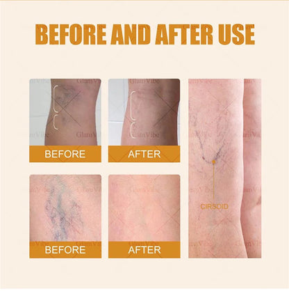 Laser Indolore Contre la Varices