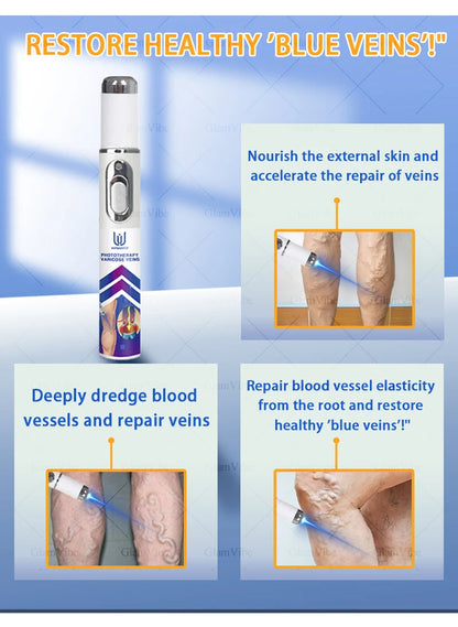 Laser Indolore Contre la Varices