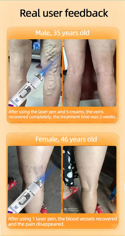 Laser Indolore Contre la Varices